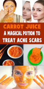 15 Best Products for Acne Scars - Healthline