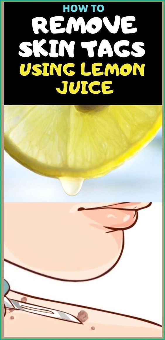 10-Effective-Ways-to-Remove-Skin-Tags-Na